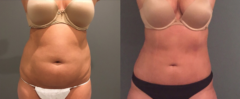 female photo before and after liposuction